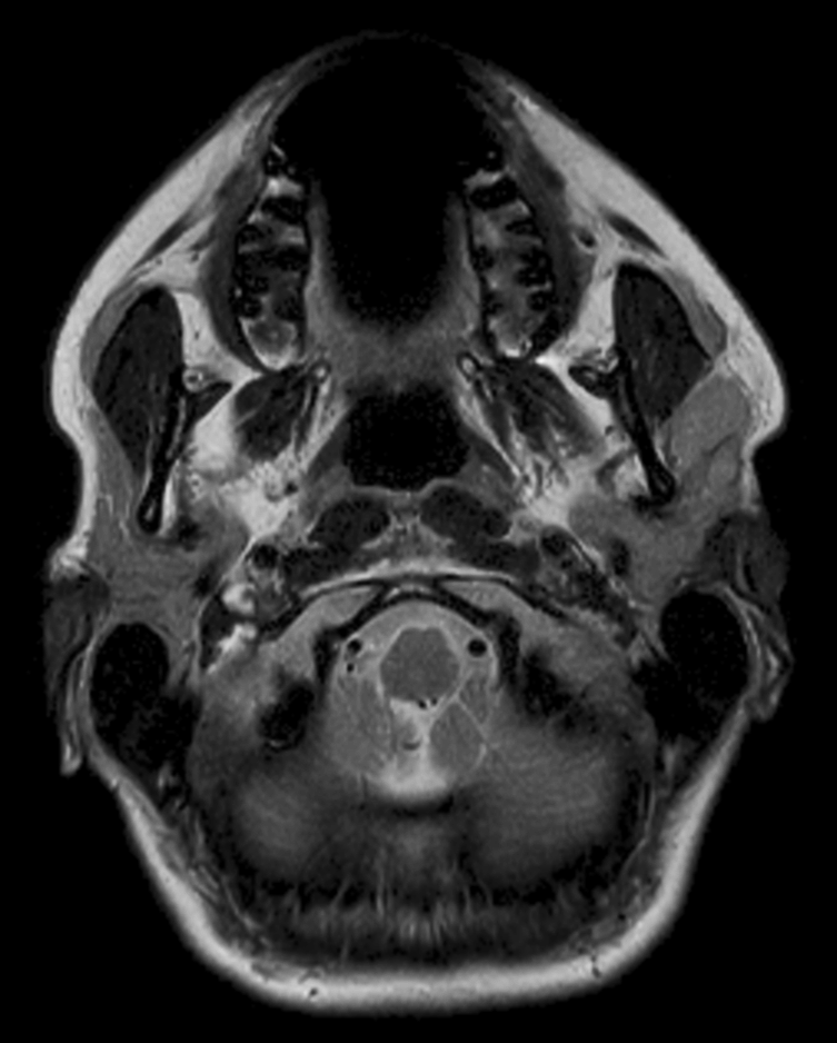 Axial T2w  mDIXON TSE (In Phase)