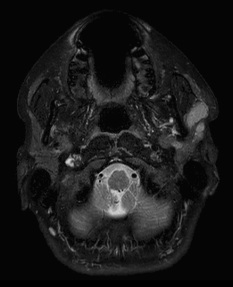 Axial T2w  mDIXON TSE (Water)