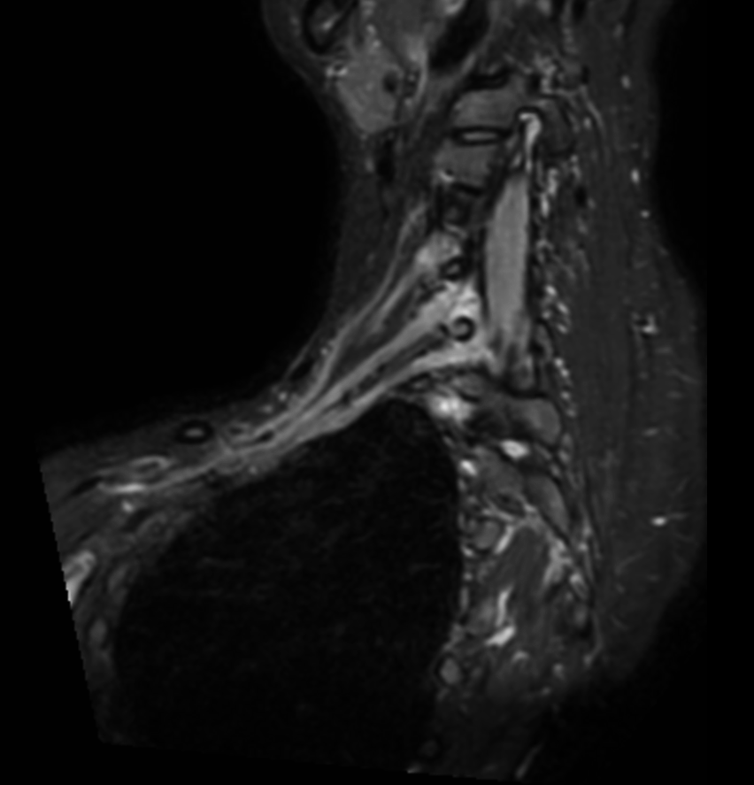 Coronal 3D STIR (oblique reformat)