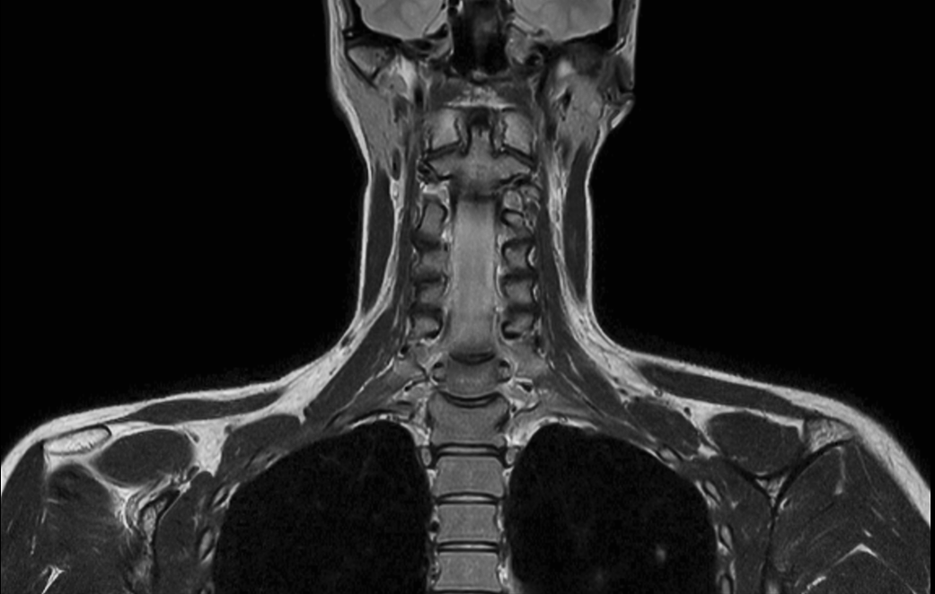 Coronal T2w  mDIXON TSE (In Phase)
