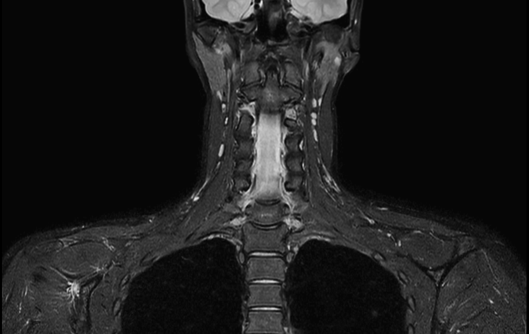 Coronal T2w  mDIXON TSE (Water)