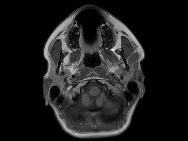 Axial T1w  mDIXON TSE (In Phase)