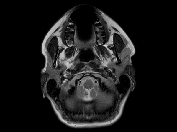 Axial T2w  mDIXON TSE (In Phase)