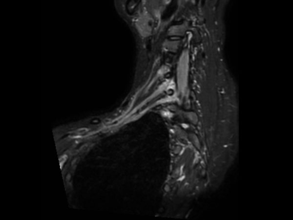 Coronal 3D STIR (oblique reformat)