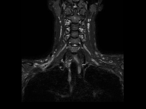 Coronal 3D STIR