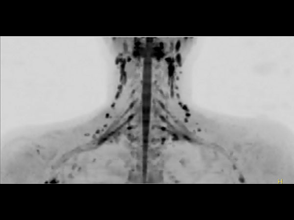 Coronal DWIBS (MIP)