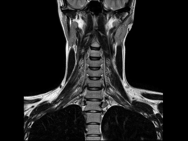 Coronal T2w TSE