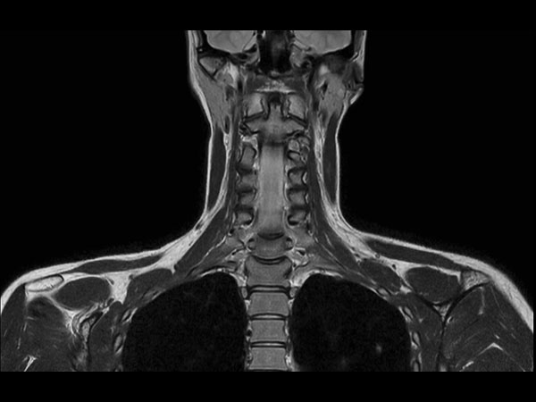 Coronal T2w  mDIXON TSE (In Phase)