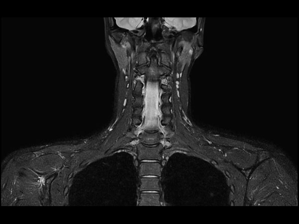 Coronal T2w  mDIXON TSE (Water)