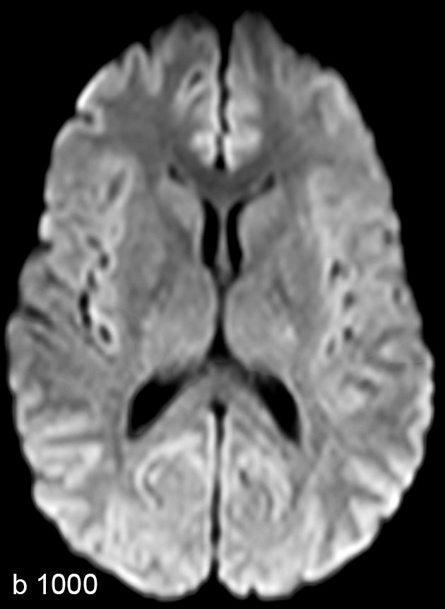 Diffusion - ComforTone