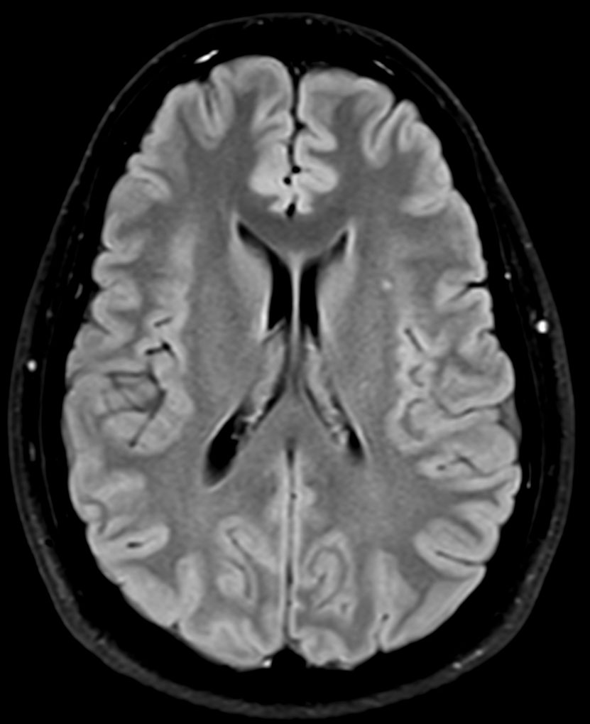 T2w FLAIR - ComforTone