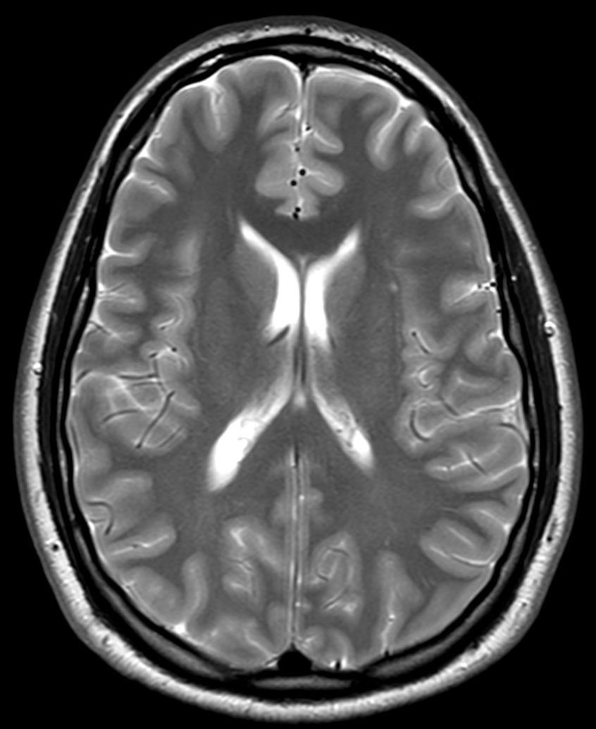 T2w TSE - ComforTone