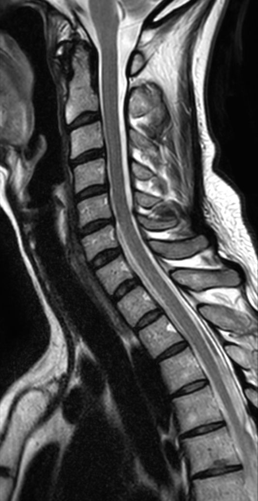 T2w TSE with ComforTone