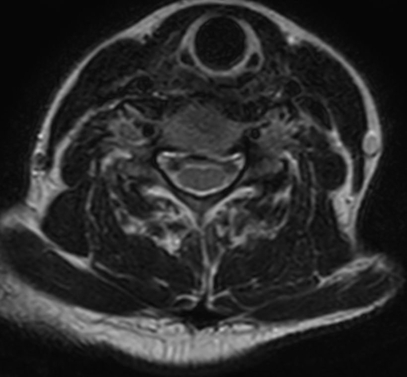 T2w TSE with ComforTone