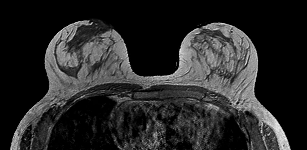 Axial dynamic 3D T1w FFE