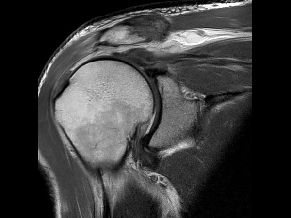 Coronal PDw aTSE