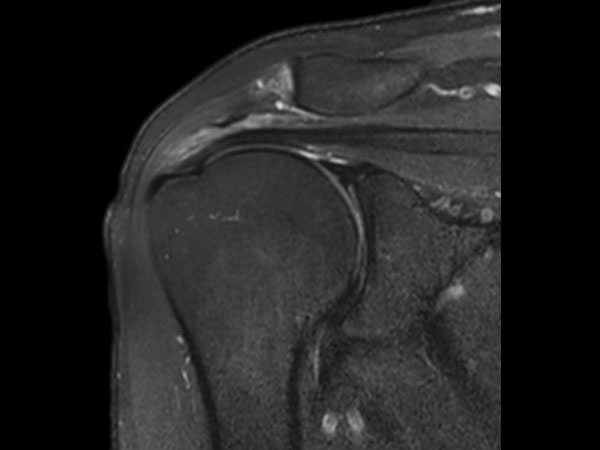 Coronal T2w SPAIR