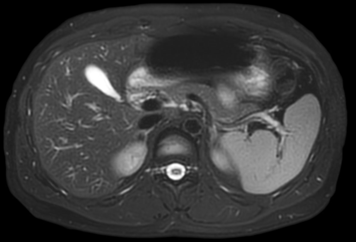 T2w SPIR – MultiVane XD