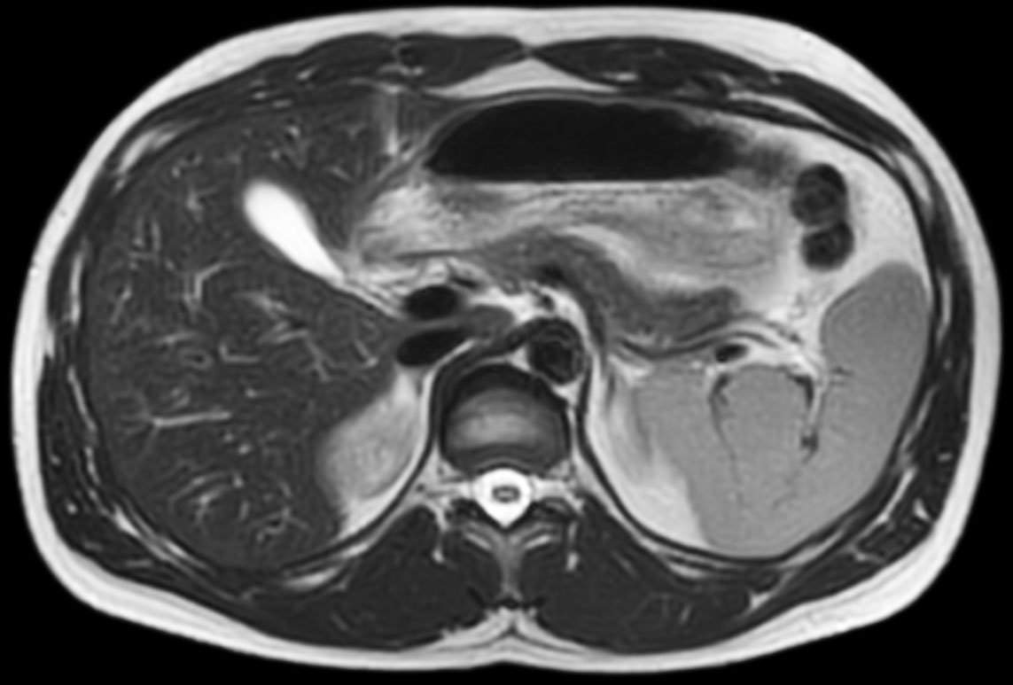 T2w TSE – MultiVane XD