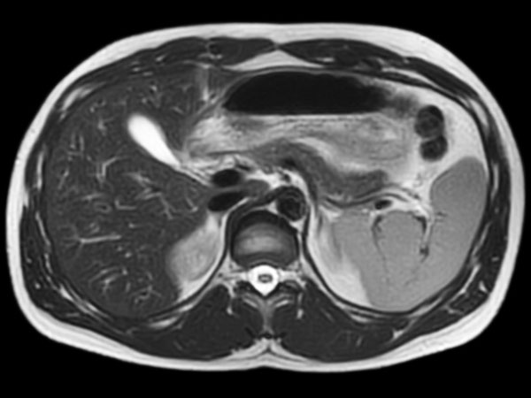 T2w TSE – MultiVane XD