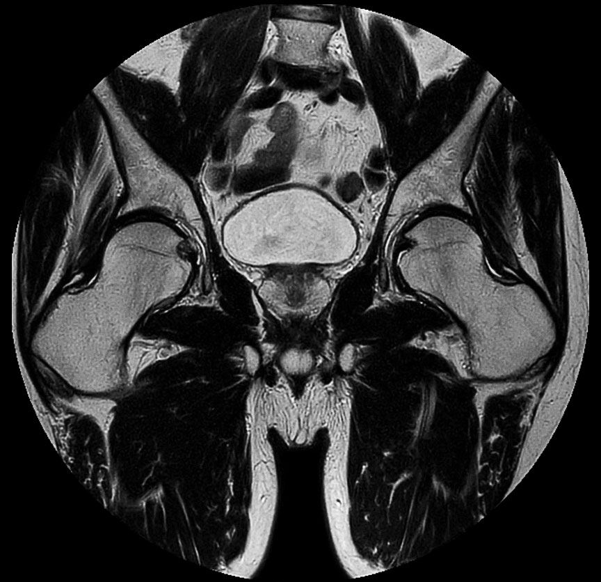 Coronal T2w MultiVane XD