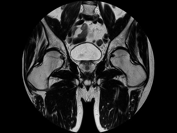 Coronal T2w MultiVane XD