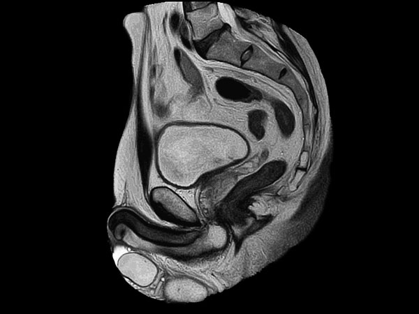 Sagittal T2w MultiVane XD