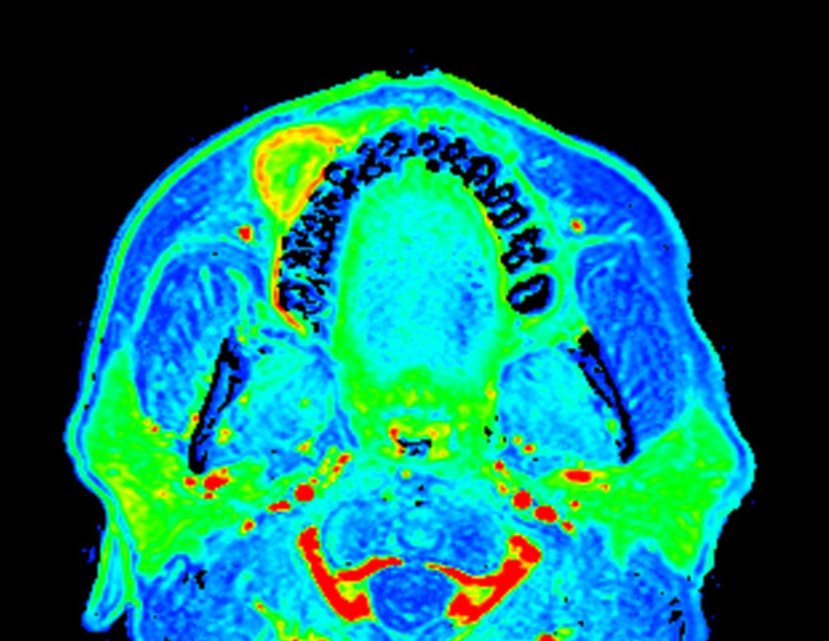 Axial eTHRIVE (max enhancement)