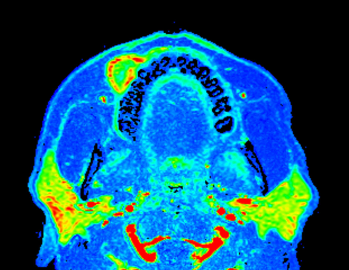 Axial eTHRIVE (wash-in)
