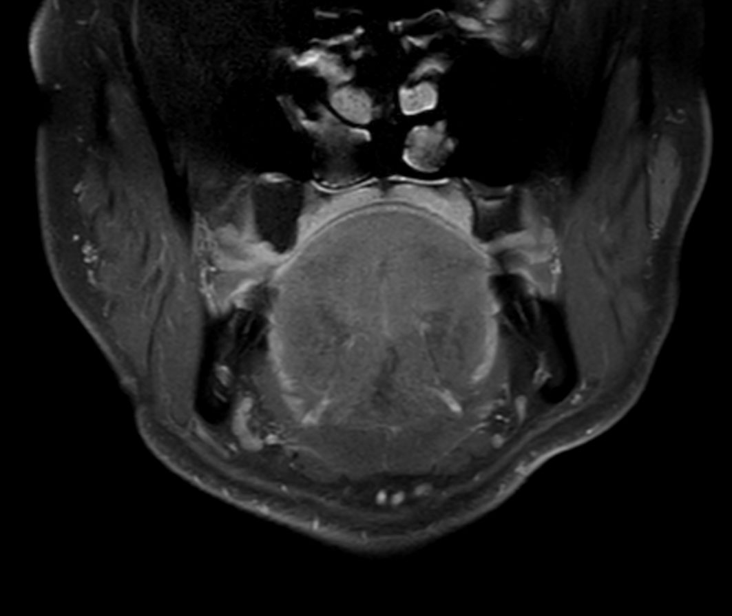 Coronal T1w TSE FatSat (post gado)