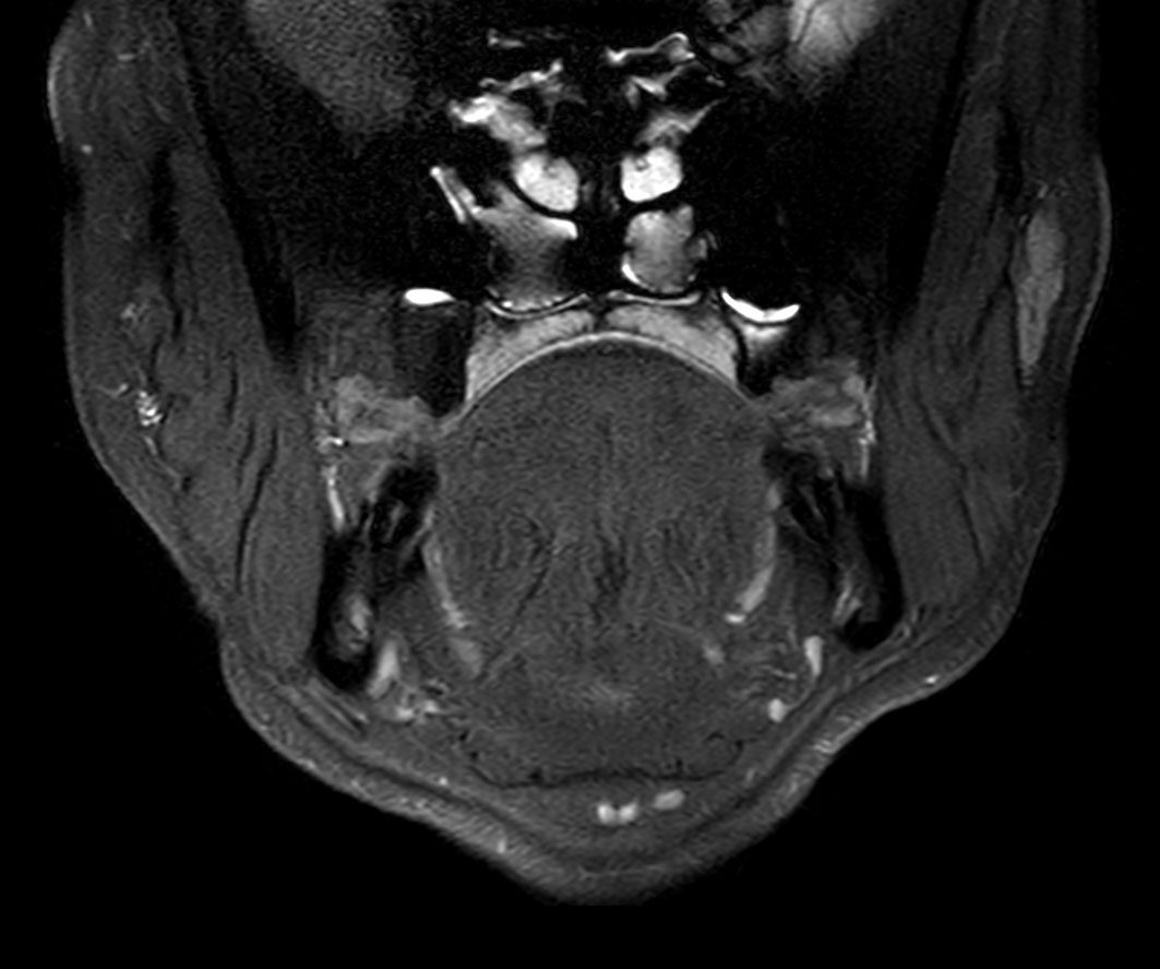 Coronal T2w TSE FatSat
