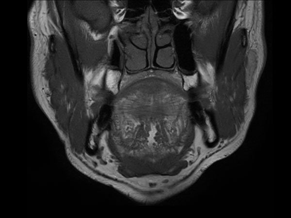 Coronal T1w TSE