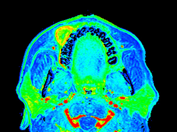 Axial eTHRIVE (max enhancement)