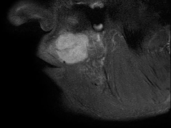 Sagittal T2w TSE FatSat