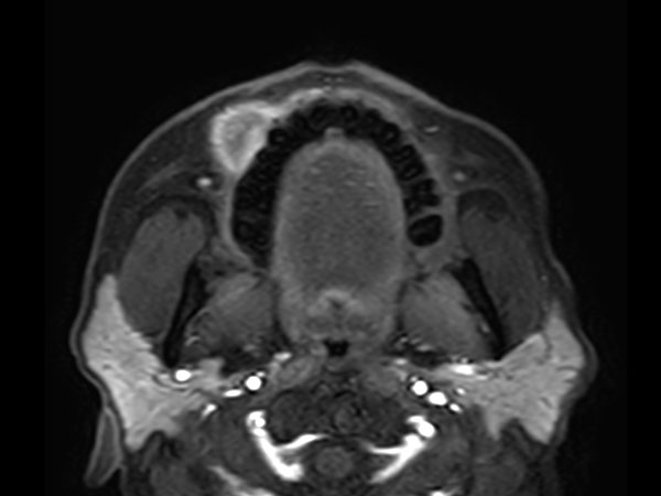 Axial eTHRIVE (1st dynamic)