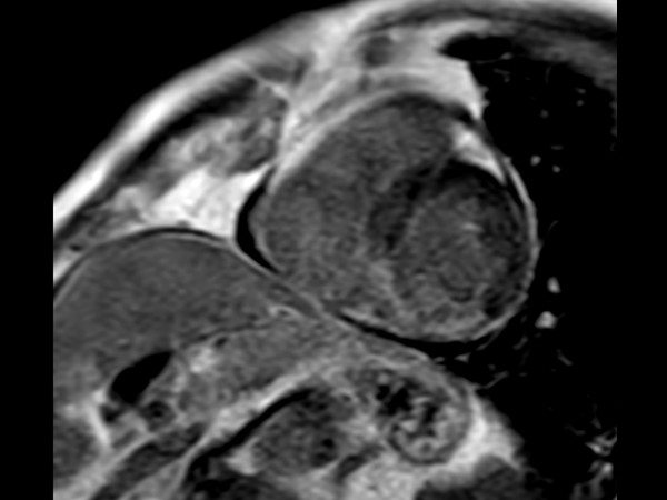 mDIXON XD FFE, short axis view (In Phase) (with gado)