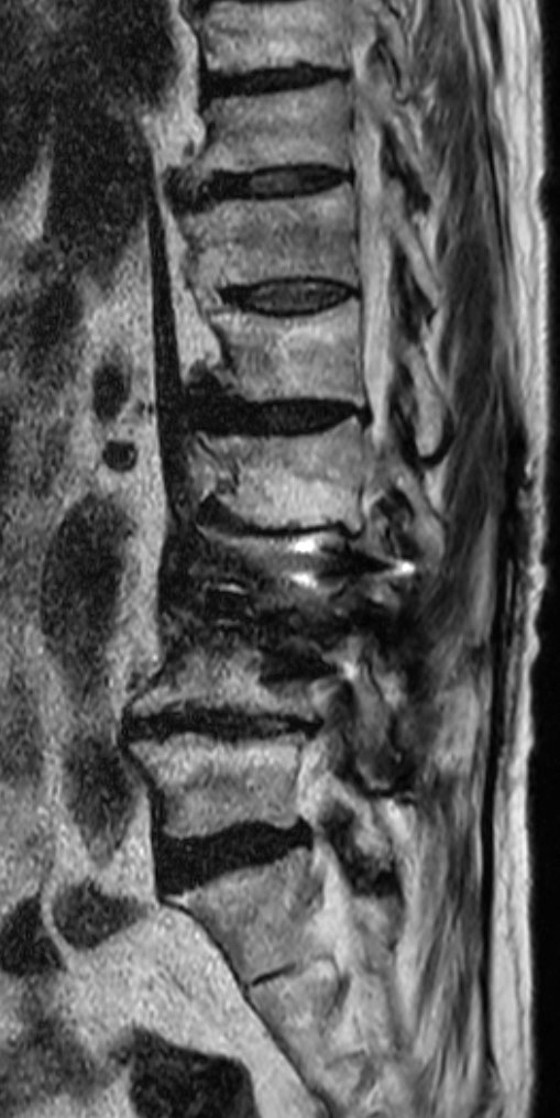 Sagittal T2w TSE O-MAR (VAT) <sup>1</sup>