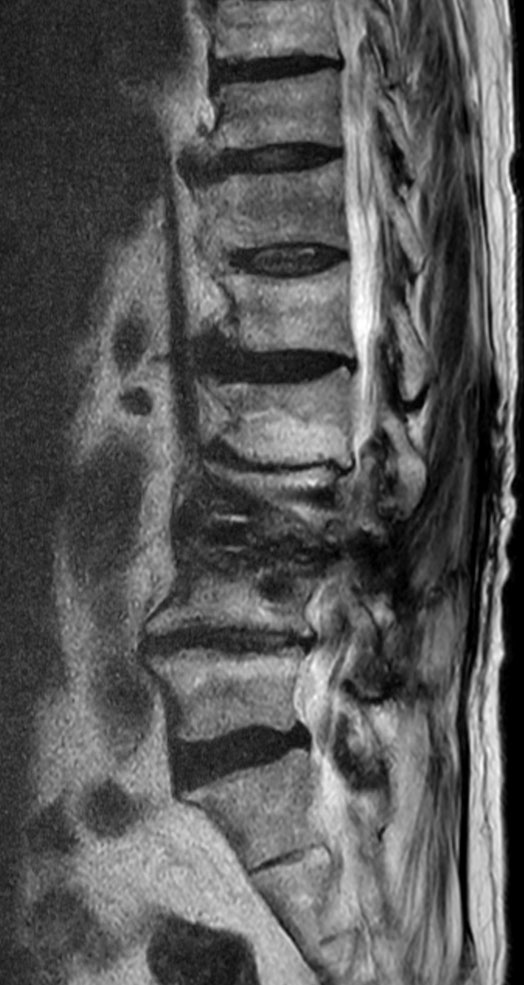 Sagittal T2w TSE O-MAR XD (VAT+SEMAC) <sup>1</sup>