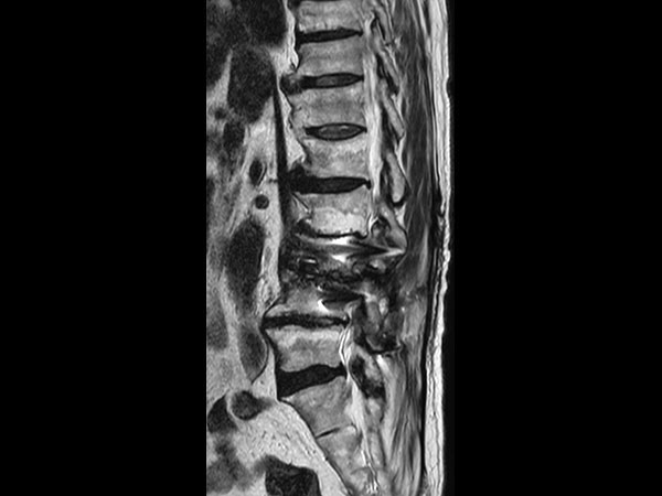 Sagittal T2w TSE