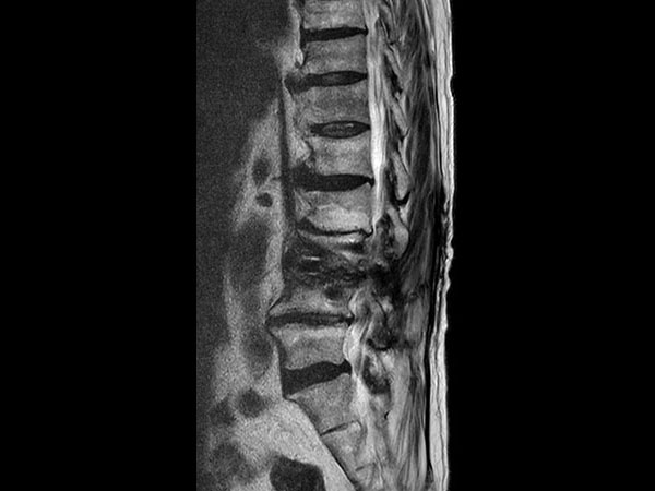 Sagittal T2w TSE O-MAR XD (VAT+SEMAC) <sup>1</sup>