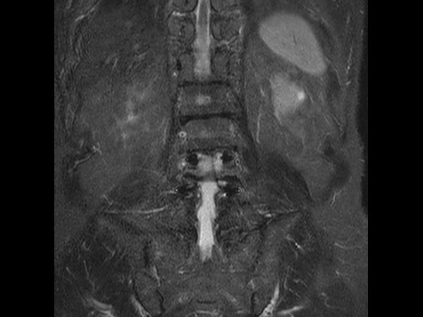 Coronal STIR TSE