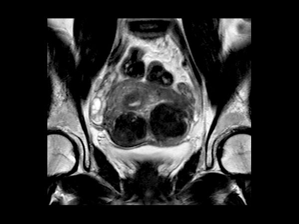 Coronal T2w TSE