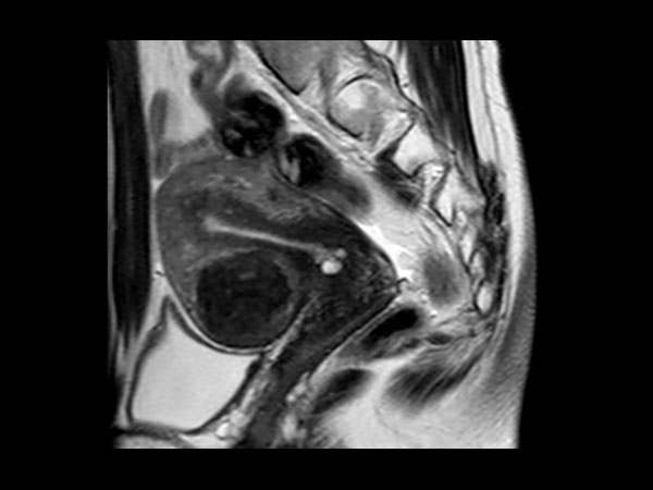 Sagittal T2w TSE