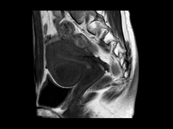 Sagittal T1w TSE