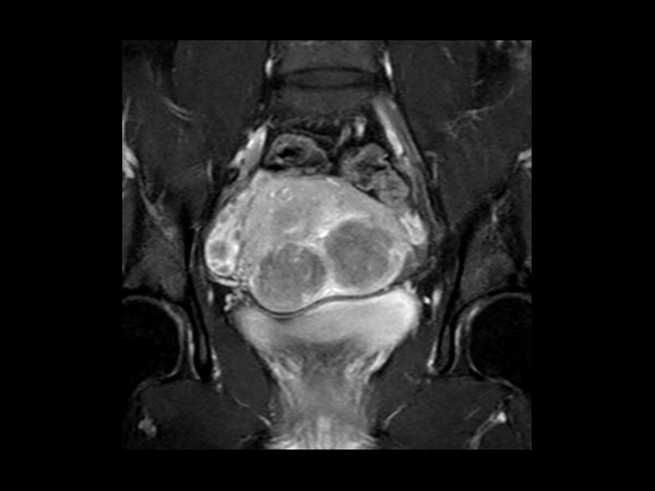 Coronal T1w SPAIR (post-gado)