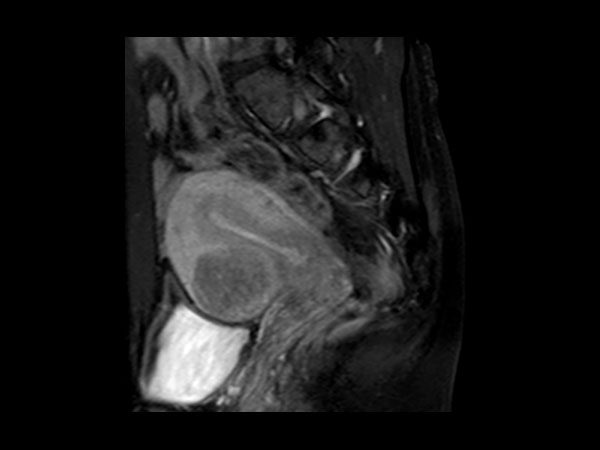 Sagittal T1w  SPAIR (post-gado)