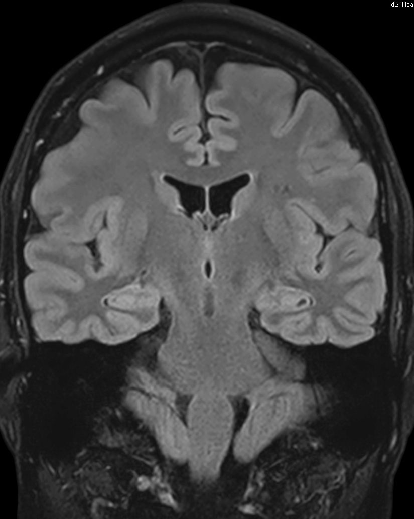 Coronal T2w FLAIR