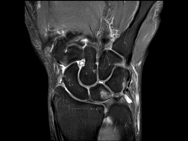 Coronal PDw SPAIR