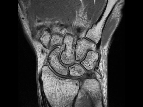 Coronal PDw TSE