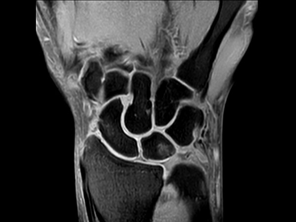 Coronal T1w SPIR